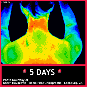Digital Thermal Imaging After 2