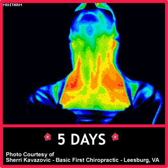 Digital Thermal Imaging After 1